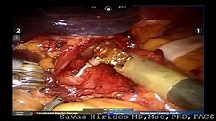 Dr SC Hirides performing a Robotic Hiatal Hernia Repair / Nissen Fundoplication - video Dailymotion
