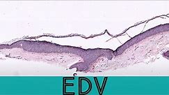 Epidermodysplasia Verruciformis (EDV) variant of flat wart verruca plana (pathology dermpath)