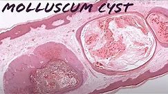 Molluscum "Cyst" (cystic molluscum contagiosum) pathology dermpath dermatology dermatopathology