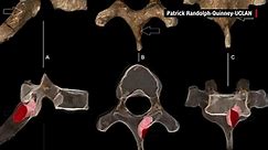 Cancer found in million-year-old fossil