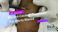 Warts/Mole Removal Treatment with Electrocautery in Jaipur, India – Dr Atul Jain