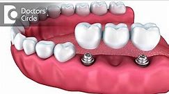 What is the difference between Dental Bridges & Dental Implants? - Dr. Naganna P M