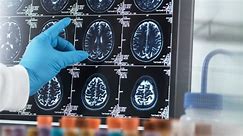 How Alzheimer's disease destroys the brain