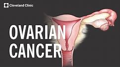 5 Warning Signs and Risk Factors of Ovarian Cancer