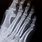 4th Metatarsal Fracture Foot