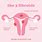 6 Cm Fibroid in Uterus