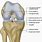 ACL Allograft