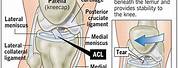ACL Ligament Injury