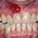 Absceso Dental