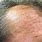 Actinic Keratosis Removal