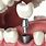 Aditamentos Implantes Dentales