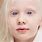 Albinismo Ocular