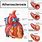 Atherosclerosis Heart Disease