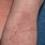Atopic Dermatitis Arm