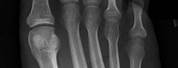 Avulsion Fracture of 5th Metatarsal of Foot