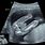 Baby Gender Ultrasound