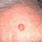 Basal Cell Carcinoma Forehead