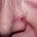 Basal Cell Carcinoma On Nose Symptoms