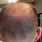 Bed Bugs On Scalp