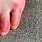 Blister Rash On Foot