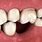 Bone Loss in Teeth