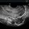 Cancer Cervix Ultrasound