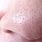 Clogged Pores On Nose