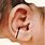 Conchal Ear