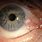 Conjunctival Lesion