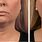 CoolSculpting for Double Chin