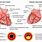 Coronary Arteries Myocardial Infarction
