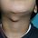 Cyst in Neck Area