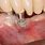 Dental Implant Bone Loss