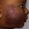 Eczema Dark Skin