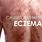 Eczema Types