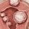 Fibroid Blood Clots