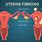 Fibroid Mass in Uterus