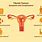 Fibroid Tumors in Uterus