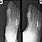 Fourth Metatarsal Fracture
