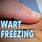 Freezing Off Warts