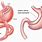 Gastric Sleeve or Bypass