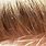 Head Lice On Hair