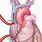 Heart Cannulation