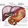 Hepatic Portal Vein and Artery