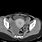Hydrosalpinx CT