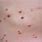 Molluscum Contagiosum Child