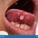 Mouth Ulcer Tongue