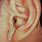 Otorrhea Ear