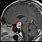 Pituitary Cyst MRI