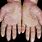 Psoriasis On Hands Symptoms